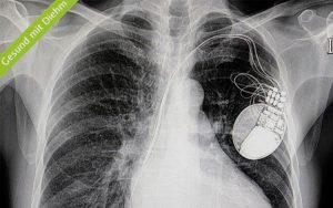 Röntgenbild mit Herzschrittmacher